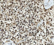 IHC staining of FFPE human breast cancer tissue with UBE2N antibody. HIER: boil tissue sections in pH8 EDTA for 20 min and allow to cool before testing.