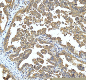 IHC staining of FFPE human ovarian cancer tissue with UBE2N antibody, HRP-secondary and DAB substrate. HIER: boil tissue sections in pH8 EDTA for 20 min and allow to cool before testing.