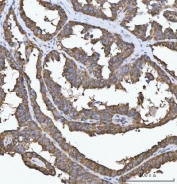 IHC staining of FFPE human ovarian cancer tissue with Delta-5 desaturase antibody. HIER: boil tissue sections in pH8 EDTA for 20 min and allow to cool before testing.