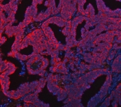 Immunofluorescent staining of FFPE human ovarian cancer tissue with Delta-5 desaturase antibody (red) and DAPI nuclear stain (blue). HIER: steam section in pH8 EDTA buffer for 20 min.