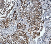 IHC staining of FFPE human lung cancer tissue with Delta-5 desaturase antibody. HIER: boil tissue sections in pH8 EDTA for 20 min and allow to cool before testing.