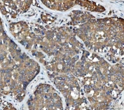 IHC staining of FFPE human liver cancer tissue with Delta-5 desaturase antibody. HIER: boil tissue sections in pH8 EDTA for 20 min and allow to cool before testing.