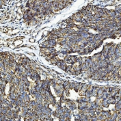 IHC staining of FFPE human urothelial carcinoma tissue with CXCR7 antibody. HIER: boil tissue sections in pH8 EDTA for 20 min and allow to cool before testing.