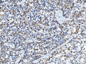 IHC staining of FFPE human breast cancer tissue with TFG antibody. HIER: boil tissue sections in pH8 EDTA for 20 min and allow to cool before testing.