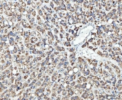 IHC staining of FFPE human liver cancer tissue with TFG antibody. HIER: boil tissue sections in pH8 EDTA for 20 min and allow to cool before testing.