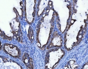 IHC staining of FFPE human ovarian cancer tissue with TFG antibody. HIER: boil tissue sections in pH8 EDTA for 20 min and allow to cool before testing.