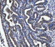 IHC staining of FFPE human cervical cancer tissue with TFG antibody. HIER: boil tissue sections in pH8 EDTA for 20 min and allow to cool before testing.
