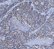 IHC staining of FFPE human lung tissue with TFG antibody. HIER: boil tissue sections in pH8 EDTA for 20 min and allow to cool before testing.