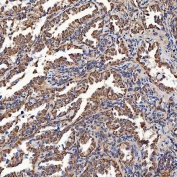 IHC staining of FFPE human lung cancer tissue with SCO1 antibody. HIER: boil tissue sections in pH8 EDTA for 20 min and allow to cool before testing.