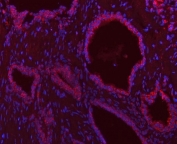 Immunofluorescent staining of FFPE human prostate cancer tissue with SCO1 antibody (red) and DAPI nuclear stain (blue). HIER: steam section in pH8 EDTA buffer for 20 min.