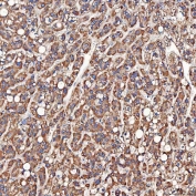 IHC staining of FFPE human liver cancer tissue with SCO1 antibody. HIER: boil tissue sections in pH8 EDTA for 20 min and allow to cool before testing.