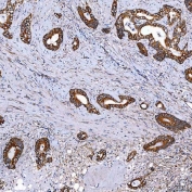 IHC staining of FFPE human colon cancer tissue with SCO1 antibody. HIER: boil tissue sections in pH8 EDTA for 20 min and allow to cool before testing.