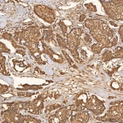 IHC staining of FFPE human breast cancer tissue with SCO1 antibody. HIER: boil tissue sections in pH8 EDTA for 20 min and allow to cool before testing.