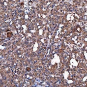 IHC staining of FFPE human thyroid cancer tissue with SCO1 antibody. HIER: boil tissue sections in pH8 EDTA for 20 min and allow to cool before testing.