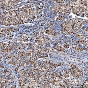 IHC staining of FFPE human cervical cancer tissue with SCO1 antibody. HIER: boil tissue sections in pH8 EDTA for 20 min and allow to cool before testing.