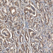 IHC staining of FFPE human prostate cancer tissue with SCO1 antibody. HIER: boil tissue sections in pH8 EDTA for 20 min and allow to cool before testing.
