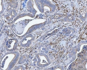 IHC staining of FFPE human colorectal adenocarcinoma tissue with Tropomyosin 2 antibody. HIER: boil tissue sections in pH8 EDTA for 20 min and allow to cool before testing.