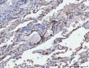 IHC staining of FFPE human lung adenocarcinoma tissue with Tropomyosin 2 antibody. HIER: boil tissue sections in pH8 EDTA for 20 min and allow to cool before testing.
