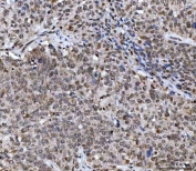 IHC staining of FFPE human lung squamous cell carcinoma tissue with UBA6 antibody. HIER: boil tissue sections in pH8 EDTA for 20 min and allow to cool before testing.