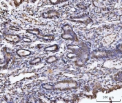 IHC staining of FFPE human cervical cancer tissue with UBA6 antibody. HIER: boil tissue sections in pH8 EDTA for 20 min and allow to cool before testing.