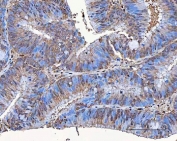 IHC staining of FFPE human colorectal adenocarcinoma tissue with Tip110 antibody. HIER: boil tissue sections in pH8 EDTA for 20 min and allow to cool before testing.