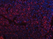 Immunofluorescent staining of FFPE human esophageal squamous carcinoma with Tip110 antibody (red) and DAPI nuclear stain (blue). HIER: steam section in pH8 EDTA buffer for 20 min.