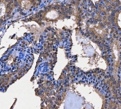 IHC staining of FFPE human breast cancer tissue with Tip110 antibody. HIER: boil tissue sections in pH8 EDTA for 20 min and allow to cool before testing.