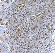 IHC staining of FFPE human laryngeal squamous cell carcinoma tissue with Tip110 antibody. HIER: boil tissue sections in pH8 EDTA for 20 min and allow to cool before testing.