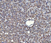 IHC staining of FFPE human liver cancer tissue with SAV1 antibody. HIER: boil tissue sections in pH8 EDTA for 20 min and allow to cool before testing.