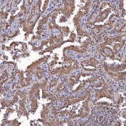 IHC staining of FFPE human lung cancer tissue with SAV1 antibody. HIER: boil tissue sections in pH8 EDTA for 20 min and allow to cool before testing.