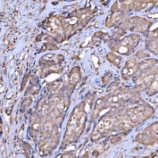 IHC staining of FFPE human breast cancer tissue with SR-BII antibody. HIER: boil tissue sections in pH8 EDTA for 20 min and allow to cool before testing.