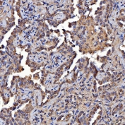 IHC staining of FFPE human lung cancer tissue with SR-BII antibody. HIER: boil tissue sections in pH8 EDTA for 20 min and allow to cool before testing.
