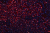 Immunofluorescent staining of FFPE human lung squamous cell carcinoma tissue with SR-BII antibody (red) and DAPI nuclear stain (blue). HIER: steam section in pH8 EDTA buffer for 20 min.