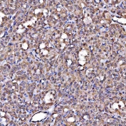 IHC staining of FFPE human thyroid cancer tissue with SR-BII antibody. HIER: boil tissue sections in pH8 EDTA for 20 min and allow to cool before testing.