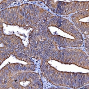 IHC staining of FFPE human endometrial cancer tissue with SR-BII antibody. HIER: boil tissue sections in pH8 EDTA for 20 min and allow to cool before testing.