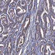 IHC staining of FFPE human prostate cancer tissue with SR-BII antibody. HIER: boil tissue sections in pH8 EDTA for 20 min and allow to cool before testing.