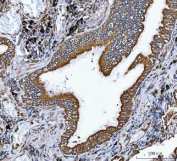 IHC staining of FFPE human lung adenocarcinoma tissue with VAPA antibody. HIER: boil tissue sections in pH8 EDTA for 20 min and allow to cool before testing.