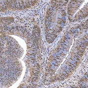 IHC staining of FFPE human colorectal adenocarcinoma tissue with SART1 antibody. HIER: boil tissue sections in pH8 EDTA for 20 min and allow to cool before testing.