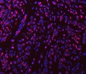 Immunofluorescent staining of FFPE human breast cancer tissue with SART1 antibody (red) and DAPI nuclear stain (blue). HIER: steam section in pH8 EDTA buffer for 20 min.
