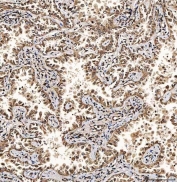 IHC staining of FFPE human lung cancer tissue with SART1 antibody. HIER: boil tissue sections in pH8 EDTA for 20 min and allow to cool before testing.