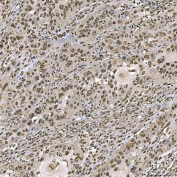 IHC staining of FFPE human laryngeal squamous cell carcinoma tissue with SART1 antibody. HIER: boil tissue sections in pH8 EDTA for 20 min and allow to cool before testing.