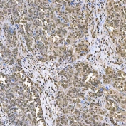 IHC staining of FFPE human ovarian cancer tissue with SART1 antibody. HIER: boil tissue sections in pH8 EDTA for 20 min and allow to cool before testing.