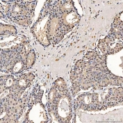 IHC staining of FFPE human breast cancer tissue with SART1 antibody. HIER: boil tissue sections in pH8 EDTA for 20 min and allow to cool before testing.