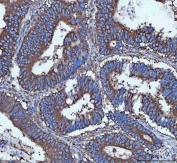 IHC staining of FFPE human colorectal adenocarcinoma tissue with Tripeptidyl-peptidase 2 antibody. HIER: boil tissue sections in pH8 EDTA for 20 min and allow to cool before testing.