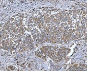 IHC staining of FFPE human lung cancer tissue with Tripeptidyl-peptidase 2 antibody. HIER: boil tissue sections in pH8 EDTA for 20 min and allow to cool before testing.