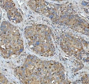 IHC staining of FFPE human liver cancer tissue with Tripeptidyl-peptidase 2 antibody. HIER: boil tissue sections in pH8 EDTA for 20 min and allow to cool before testing.