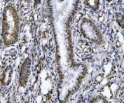 IHC staining of FFPE human cervical cancer tissue with ZMYND8 antibody. HIER: boil tissue sections in pH8 EDTA for 20 min and allow to cool before testing.
