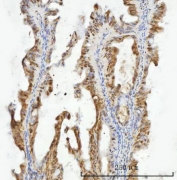 IHC staining of FFPE human ovarian cancer tissue with ZMYND8 antibody. HIER: boil tissue sections in pH8 EDTA for 20 min and allow to cool before testing.