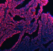 Immunofluorescent staining of FFPE human ovarian cancer tissue with UBC12 antibody (red) and DAPI nuclear stain (blue). HIER: steam section in pH8 EDTA buffer for 20 min.