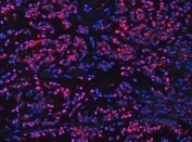 Immunofluorescent staining of FFPE human breast cancer tissue with UBC12 antibody (red) and DAPI nuclear stain (blue). HIER: steam section in pH8 EDTA buffer for 20 min.